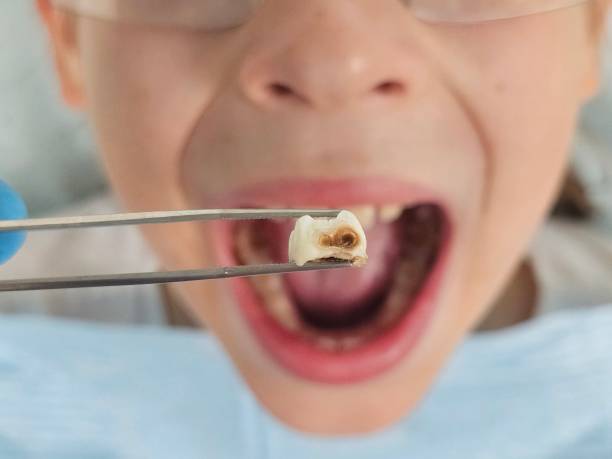 Best Emergency Dental Care for Broken or Chipped Teeth in Galls, IN