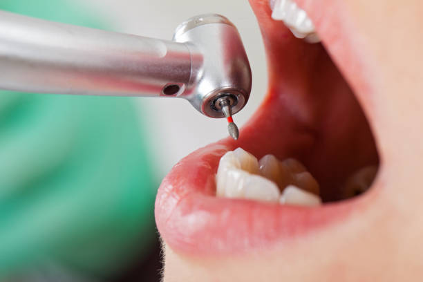 Best Emergency Root Canal Treatment in Galls, IN